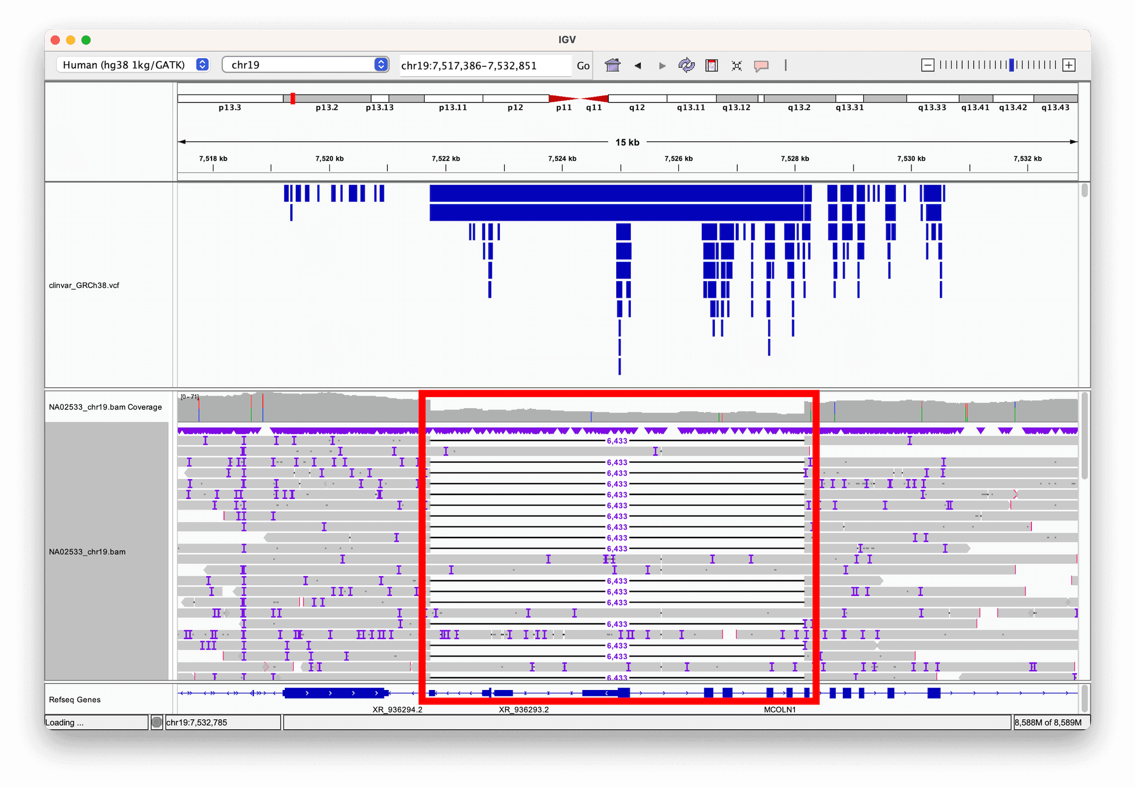 IGV view of a large deletion visible via split long reads, with a ClinVar VCF annotation track